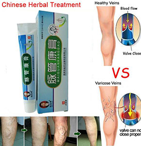 [2159] Medical Varicose Veins Treatment Leg Acid Bilges Itching Lumps Vasculitis